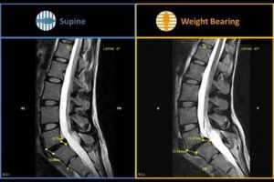 Anterolisthesis  Facet Joint Instability