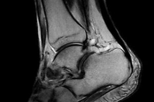 FSE - T2 - Sagittal