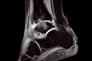 STIR - Sagittal